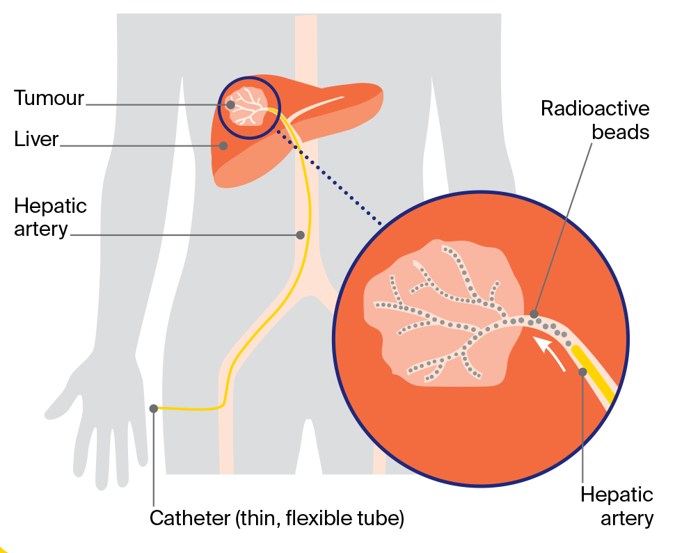 Diagram of selective internal radiation therapy (SIRT) where a catheter is inserted to deliver radioactive beads directly to a liver tumour.