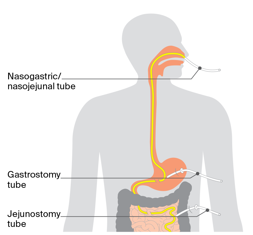 Diagram showing feeding tubes, including a nasogastric tube through the nose and gastrostomy or jejunostomy tubes through the abdomen to the stomach or bowel.