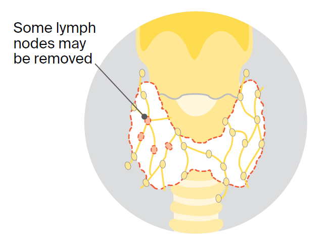 Diagram of the neck showing the thyroid gland outlined with a dashed red line and surrounding lymph nodes. Several lymph nodes on one side of the neck are highlighted to indicate removal during thyroid cancer surgery. An arrow points to the highlighted lymph nodes with the label, “Some lymph nodes may be removed."