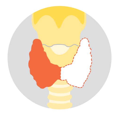 Diagram of the neck showing a partial thyroidectomy. One lobe of the thyroid gland is shaded orange to indicate the section being removed, while the remaining lobe is shown as an outlined shape.