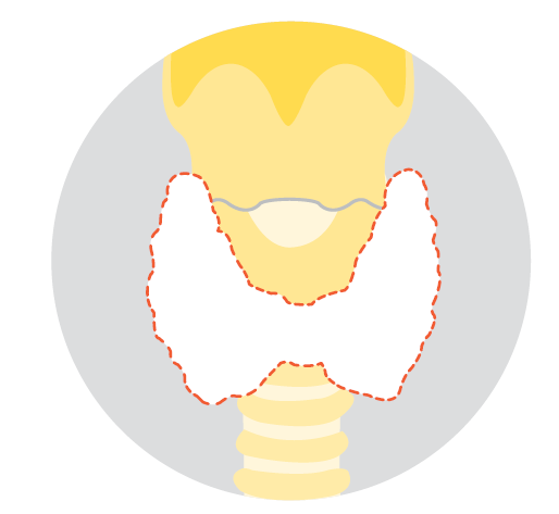 Diagram of the neck showing the thyroid gland outlined with a dashed red line, representing a total thyroidectomy in which the entire thyroid gland is removed.