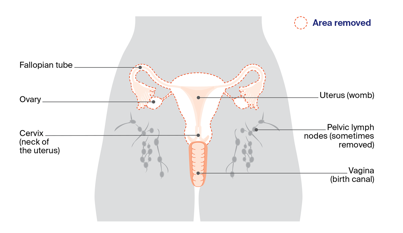 Diagram showing the reproductive areas removed during a total hysterectomy and bilateral salpingo-oophorectomy, may also include pelvic lymph nodes.