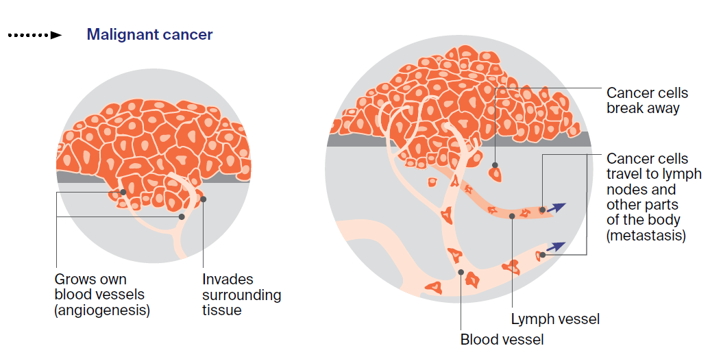 Diagram showing cancer cells breaking away from the tumour, travelling through the blood to the lymph nodes and affecting other organs.