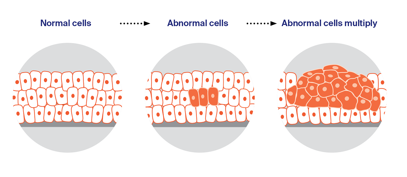 Diagram showing normal cells similar, abnormal cells appear among the normal cells and multiplying to form a large cluster called a malignant tumour.