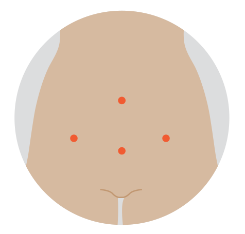 Illustration of 4 small keyhole surgery incisions.
