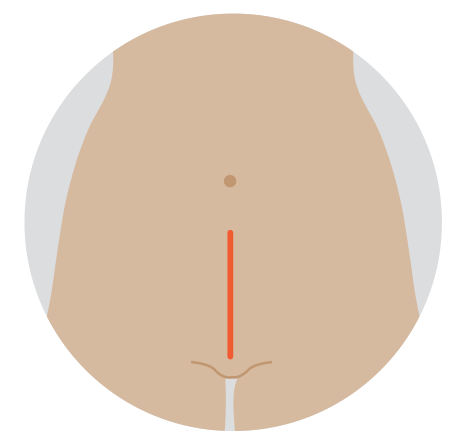 Illustration of the open surgery cut that is usually made from the pubic area to the bellybutton.