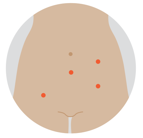 Illustration of 4 small robotic-assisted hysterectomy incisions
