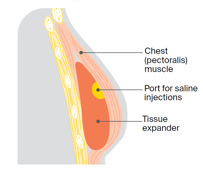 Illustration of first stage of two-stage operation with a tissue expander.