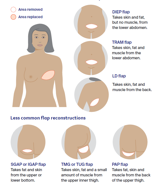 Infographic showing the different locations of flap reconstructions.