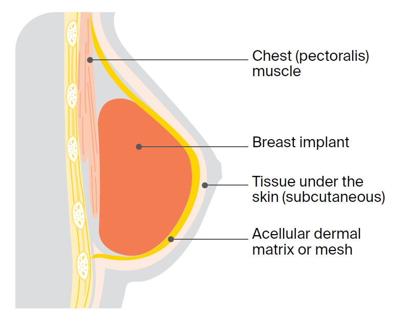 Illustration of a prepectoral implant reconstruction.