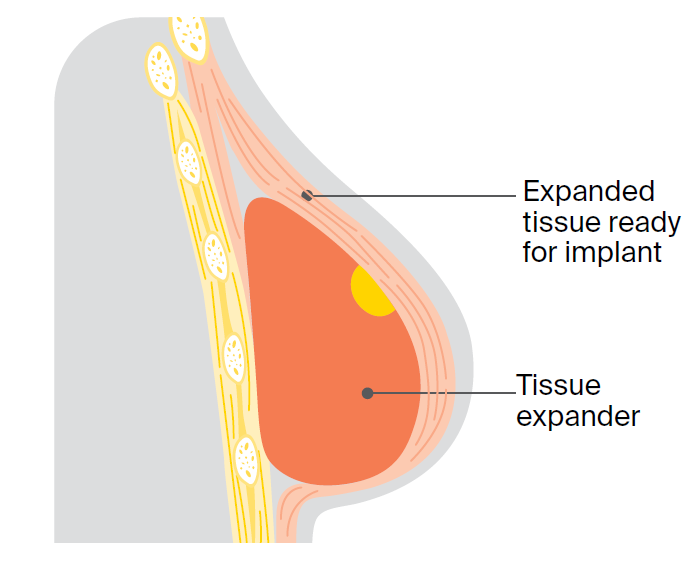 Illustration of second stage of two-stage operation with a tissue expander.