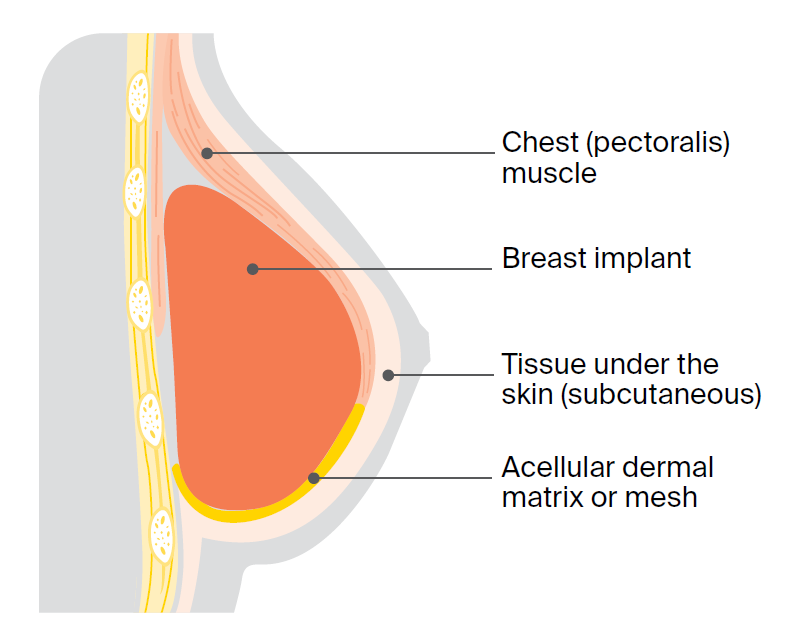 Illustration of a subpectoral implant reconstruction.