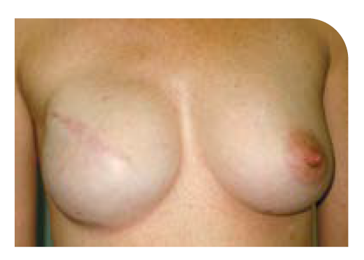 Illustration of a reconstructed breast showing a surgical scar. The location and appearance of the scar vary depending on the incision chosen by the breast surgeon and reconstructive (plastic) surgeon during surgery.