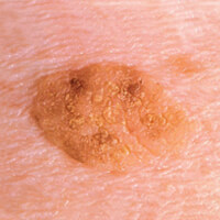 Photo of an age spot, showing a raised area on the skin that feels rough, which is a type of non-cancerous skin spot.