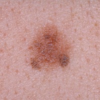 Photo of an irregular mole, large with an irregular shape and uneven colour, which is a type of non-cancerous skin spot.