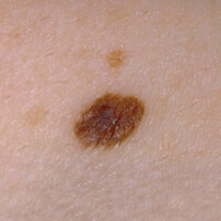 Photo of a mole, showing brown, black or the same colour as your skin, which is a type of non-cancerous skin spot.