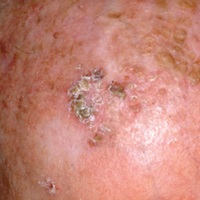 Photo of a squamous cell carcinoma (SCC) showing a thick scaly lesion. SCC is a type of non-melanoma skin cancer (keratinocyte cancer).