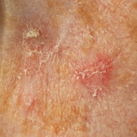 Photo of a sunspot, showing a flat scaly spot, which is a type of non-cancerous skin spot.
